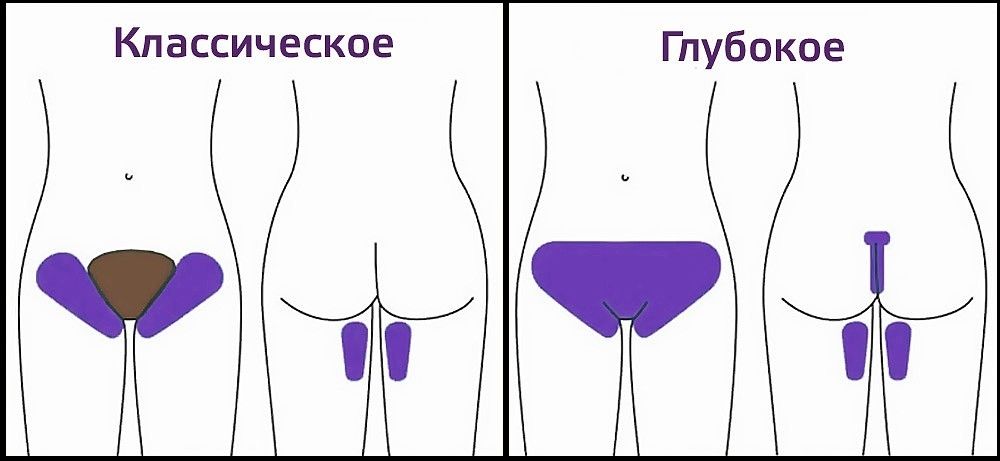 зона бикини